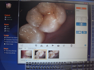 歯科用口腔内カメラ